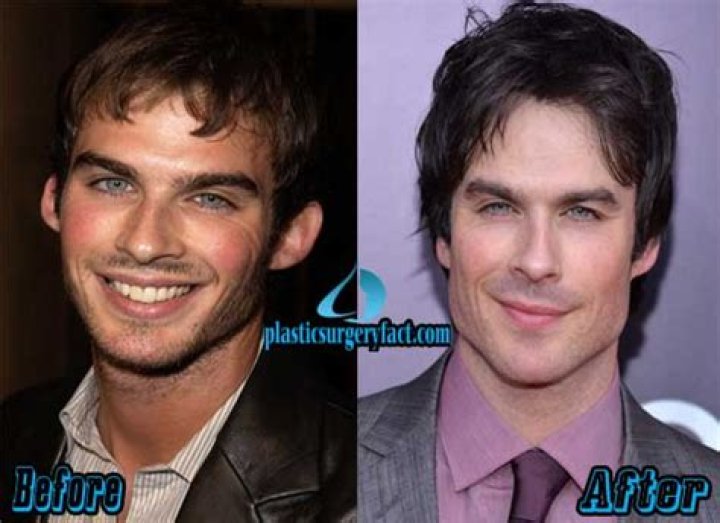 Ian Somerhalder's Plastic Surgery Journey