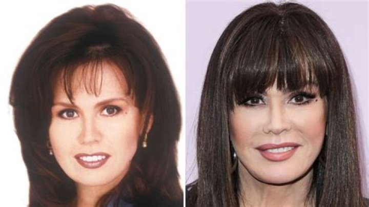 Unveiling the Truth Behind Donny Osmond Plastic Surgery